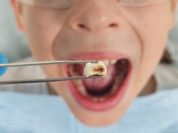 Best Chipped Tooth Repair Near Me  in Gruetli Laager, TN